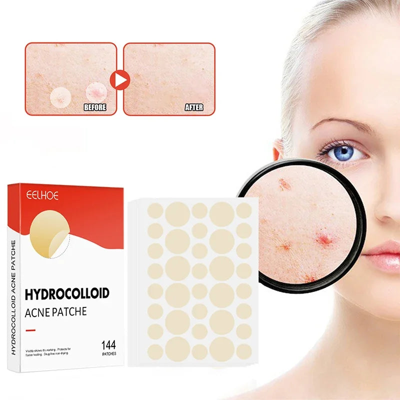 Acne pimple patch 144pcs/set